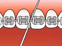 牙套人在学校怎么刷牙,如何戴着牙套正确刷牙
