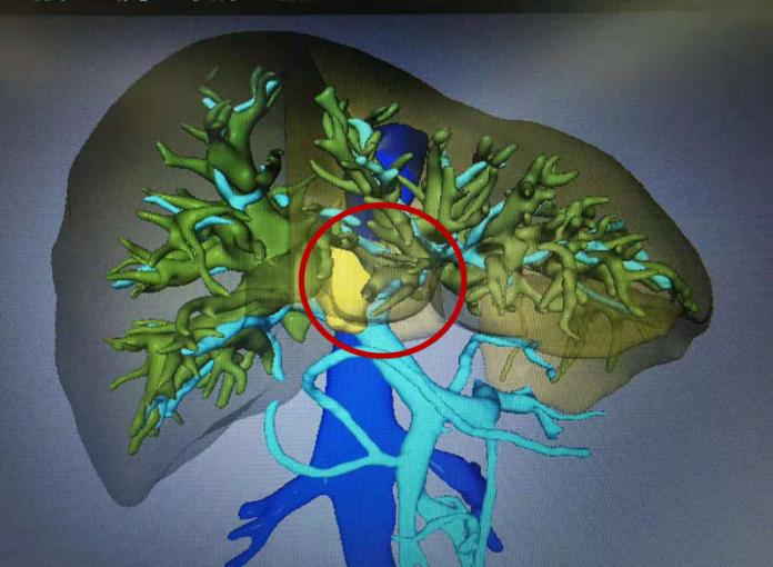 肝门部胆管癌内镜下微创治疗,哈医大一院切除肝脏