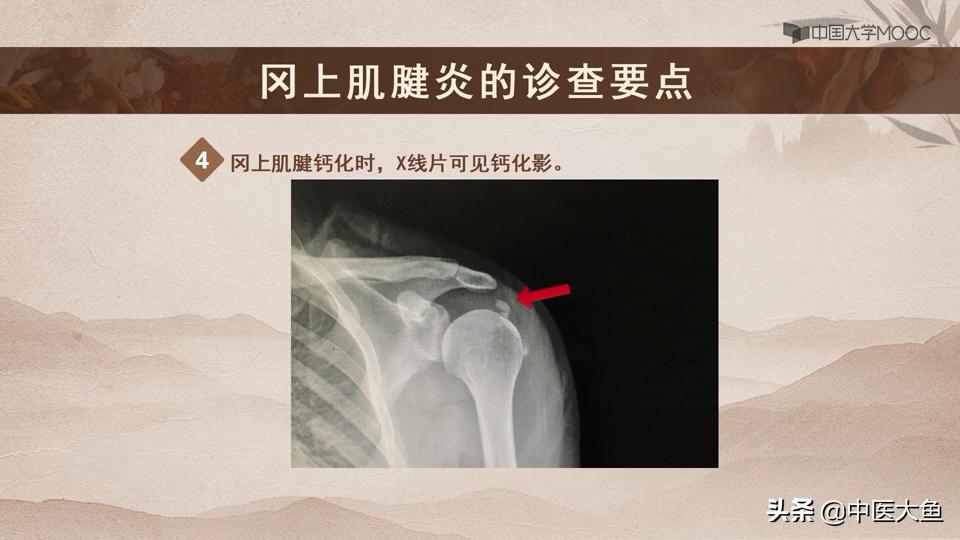 冈上肌腱炎的体征,冈上肌肌腱炎的症状及治疗