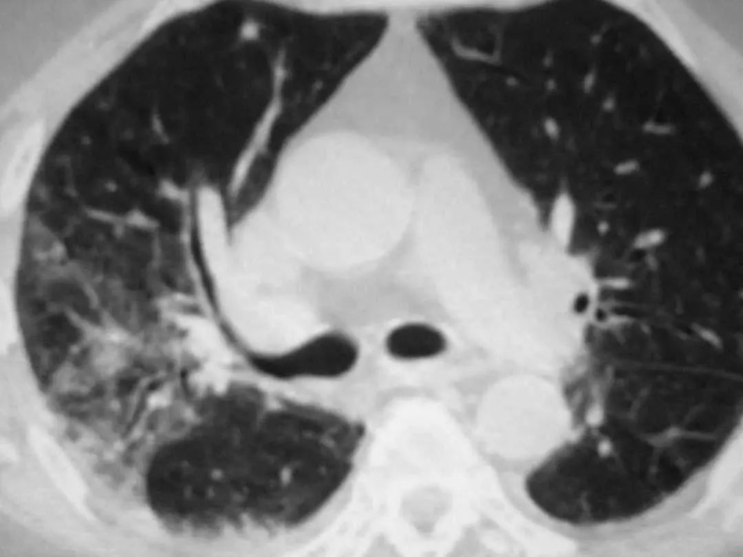 肺炎炎症图片,肺炎病历单图片