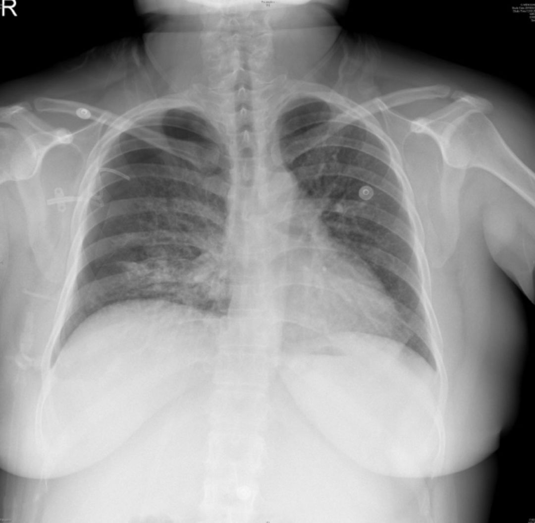 女性气胸的十大症状,女性气胸的十个表现