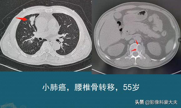 肺癌晚期胃癌,肺癌和胃癌晚期的状况