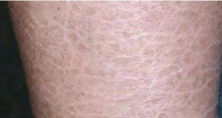 脚干裂脱皮鱼鳞状,小腿干裂起鱼鳞是怎么回事