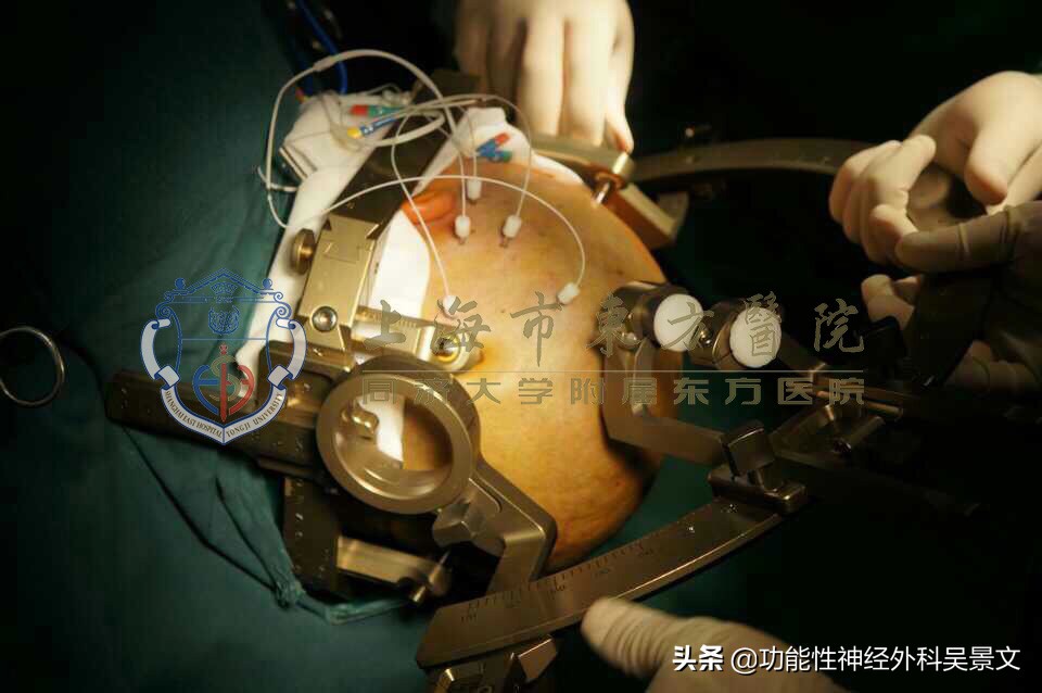 seeg微创手术技术,seeg微创怎么治疗癫痫