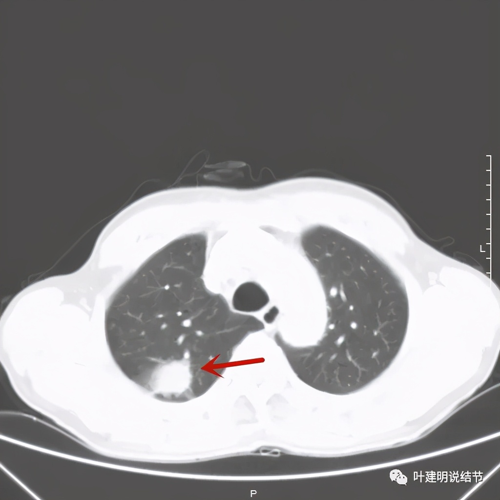 肺占位病理活检无病变,肺部占位穿刺病理说不确定性质