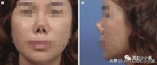 鼻子怎么修复好看呢,鼻型修复方法大全