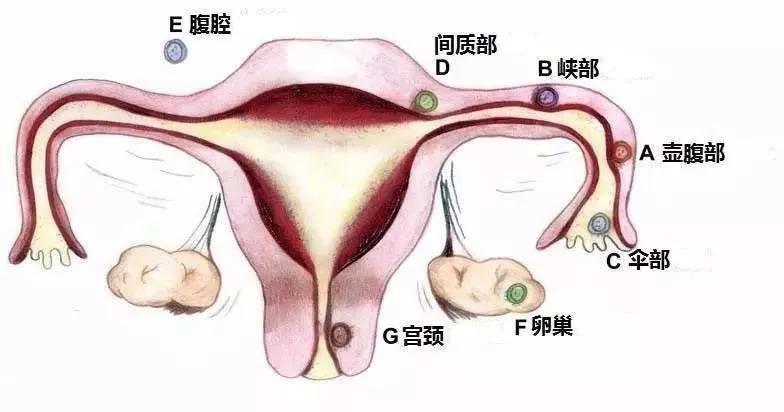 宫外孕“喜欢”什么样的女性?你也在其中吗