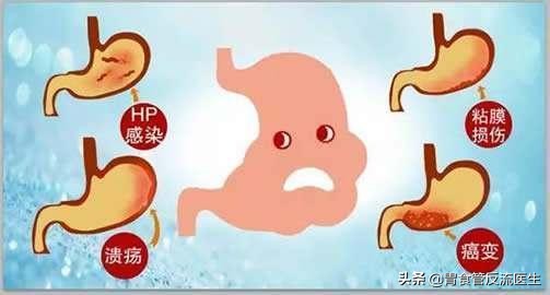 胃酸是怎么来的，为什么我感觉胃里是酸的，嘴巴也是酸的？