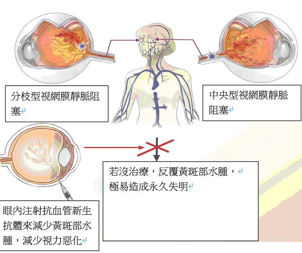 好消息关于医保,眼底病手术费进医保吗