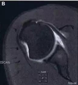 特殊骨折类型,特殊骨折体征