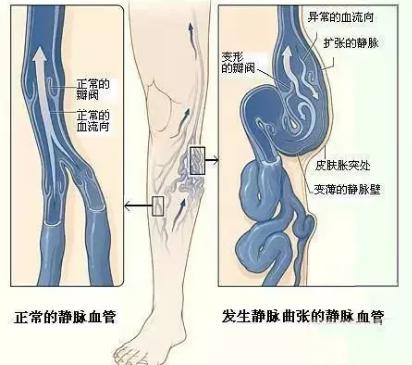 腿上长蚯蚓有哪些东西要戒掉,腿上有小蚯蚓怎么办