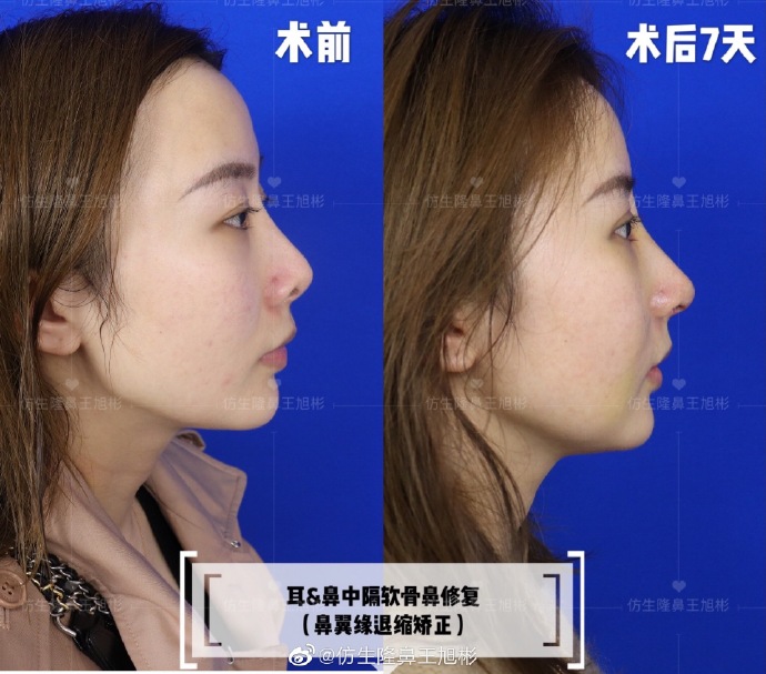 假体隆鼻耳软骨垫鼻尖图片,l型假体耳软骨隆鼻图片