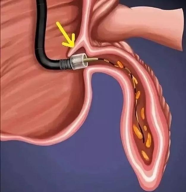 怎么让阑尾炎不复发,不开刀也能治愈阑尾炎