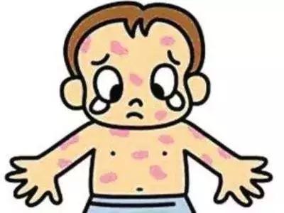孩子喉咙痛低烧然后身上起疹子,儿童持续低热出疹喉咙痛