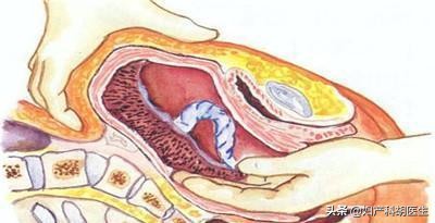 孕妇胎盘辟谣,一胎胎盘粘连后又怀孕不想要了