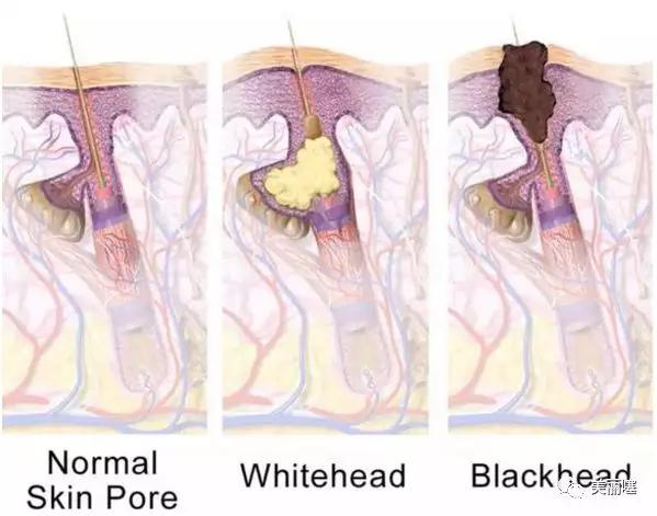 牙膏真的可以去粉刺吗,牙膏对鼻子黑头有什么作用
