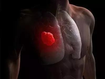 晚期肺癌治疗的前世与今生