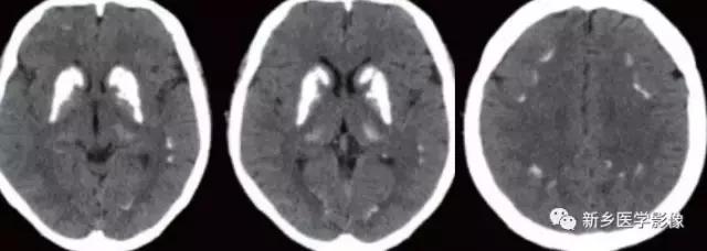 颅内有钙化怎么治疗,34岁脑部有钙化正常吗