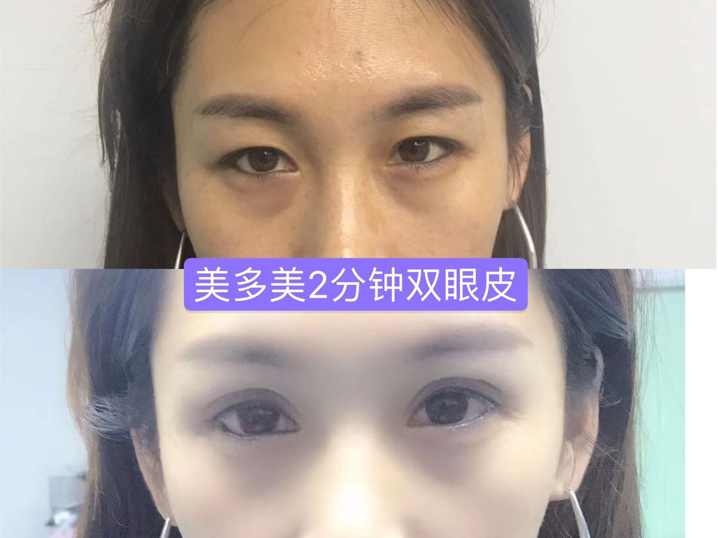 双眼皮手术睁眼闭眼效果,双眼皮手术怎么看着不假