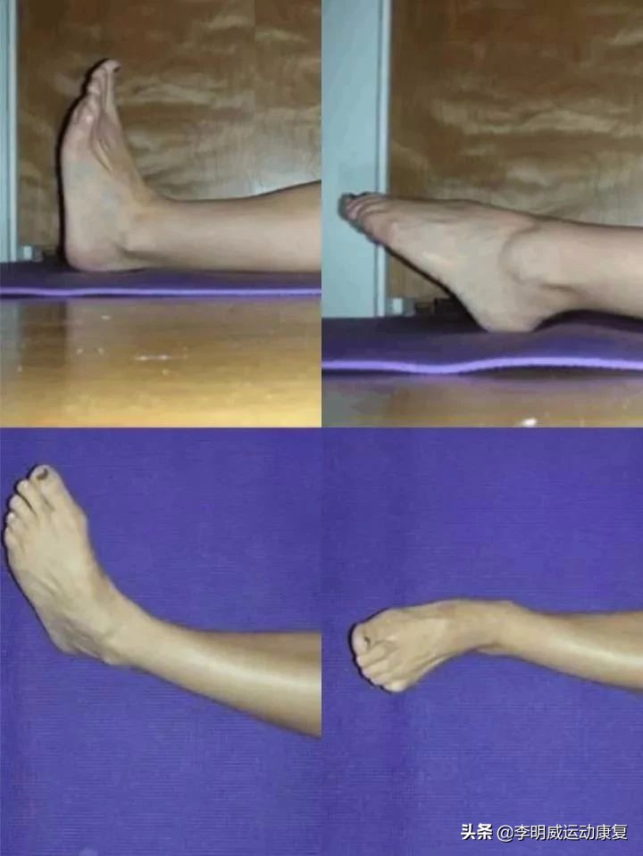 轻度脚踝扭伤的处理方法及康复,脚踝扭伤康复训练6种简单方法