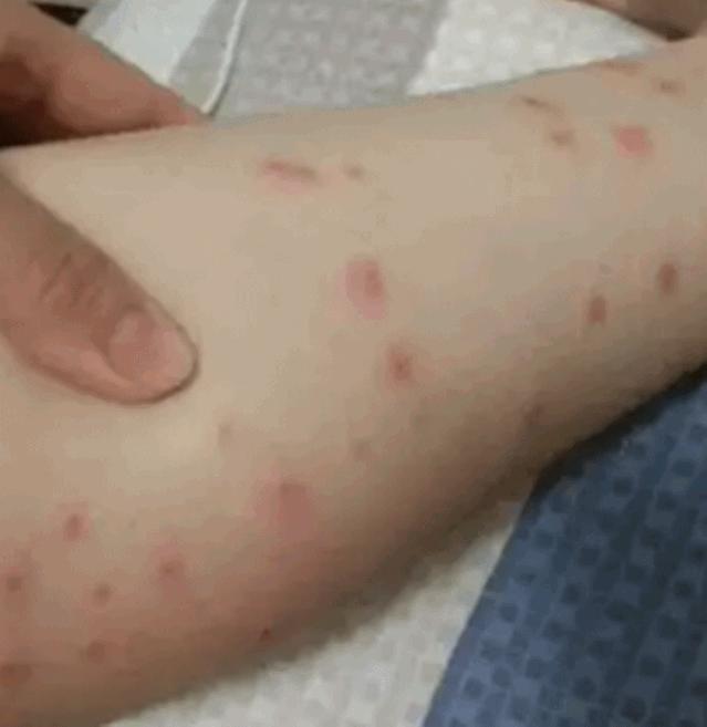 有一种小飞虫比蚊子小咬得特别疼,有一种小虫叫蠓子叮人很厉害