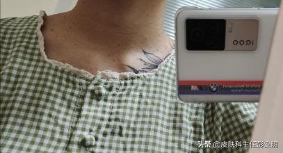 银屑病抗争经历,我与鱼鳞病的抗争