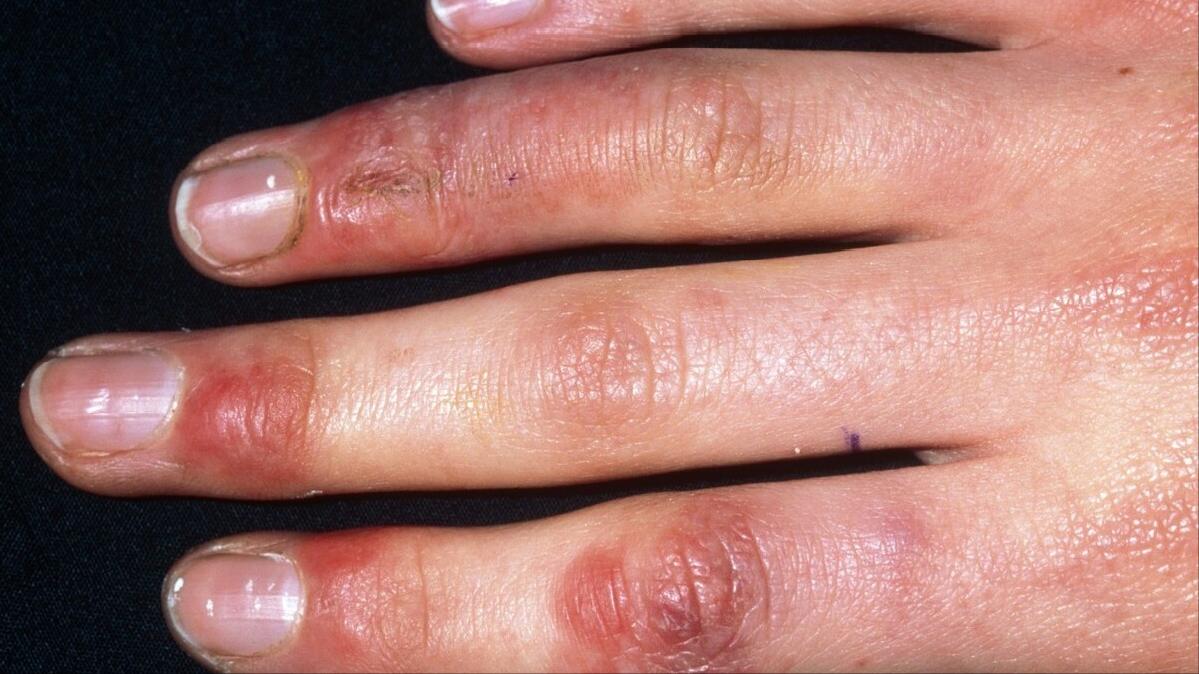 如何告别顽固性冻疮,防治冻疮的小窍门