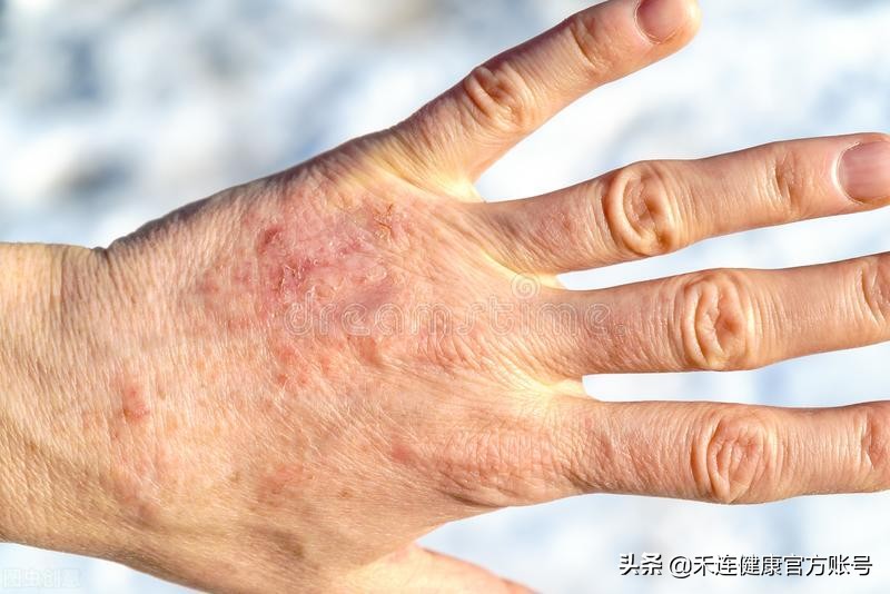 身上长小红点是肝不好吗,肝出什么问题身上会有小红点