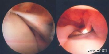 陈旧性踝关节损伤的治疗,踝关节损伤现场处理视频