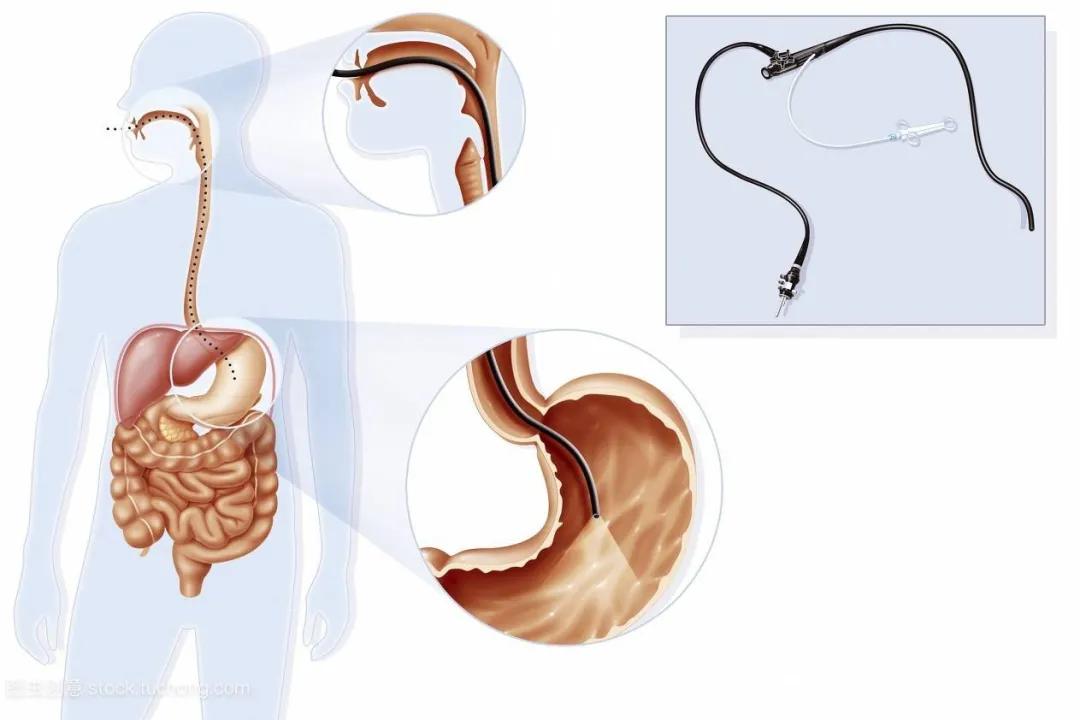 萎缩性胃炎有多大几率转变为胃癌,慢性萎缩性胃炎几年可以变成胃癌