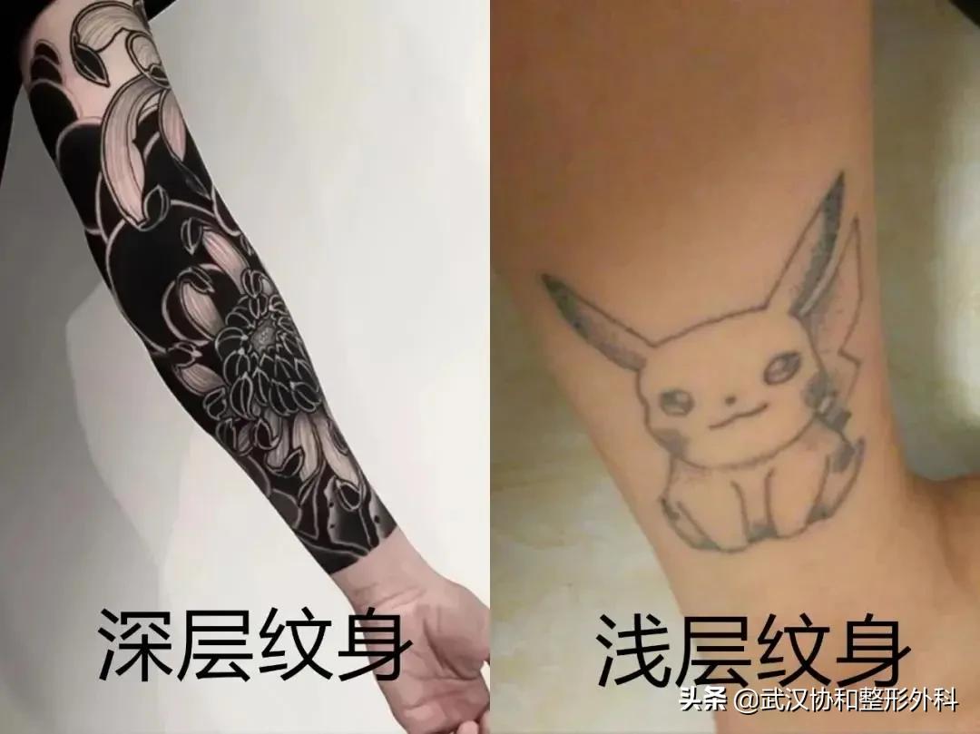 激光洗纹身出血吗,洗纹身是什么体验