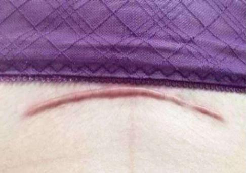 如果是剖腹产疤痕体质怎么办,剖腹产难看的疤痕教你轻松美化