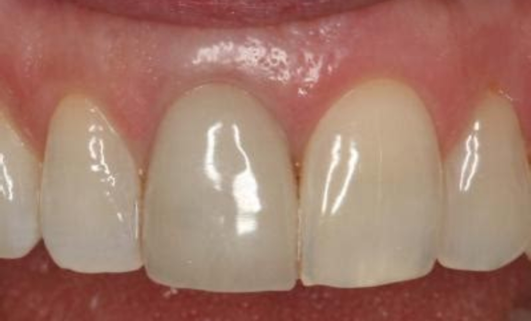 上门牙磕破了一小块怎么办,上门牙磕掉了怎样处理伤口