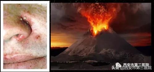 脸上全是痘真正有效的办法,脸上长小痘痘不疼不痒是什么痘