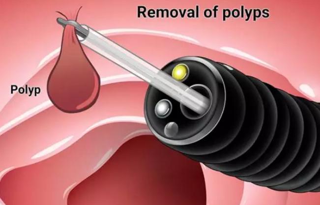 哪三类人最容易长肠息肉医师解答,肠息肉有啥症状北京医院解答