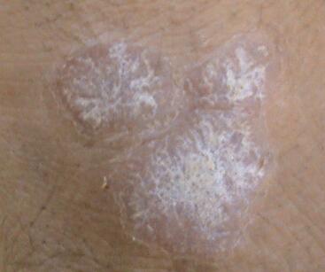 银屑病苏金单抗多久见效,中重度银屑病外用药