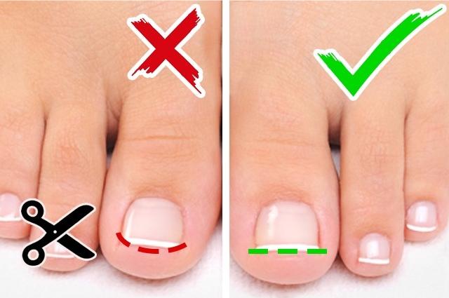 甲沟炎指甲陷肉里拔不出来怎么办,脚趾甲长进肉里怎么办小妙招