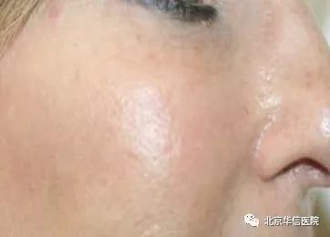 光子嫩肤帮你逆袭光滑细嫩状态,光子嫩肤让你拥有蛋壳般肌肤