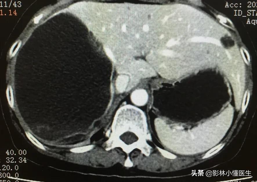 肝囊肿介入治疗后能维持多长时间,肝囊肿1.4*1.1需要治疗吗