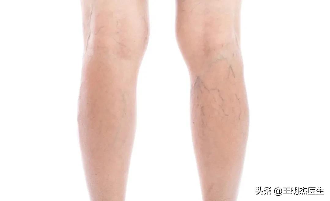 静脉曲张是谣言吗,静脉曲张不治疗恶化的速度快吗