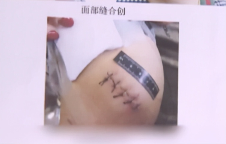 因与两个男人纠缠不清，上海女子被前男友划伤脸部致29厘米长伤疤！事后女子称：前男友真心爱我，会等他出来