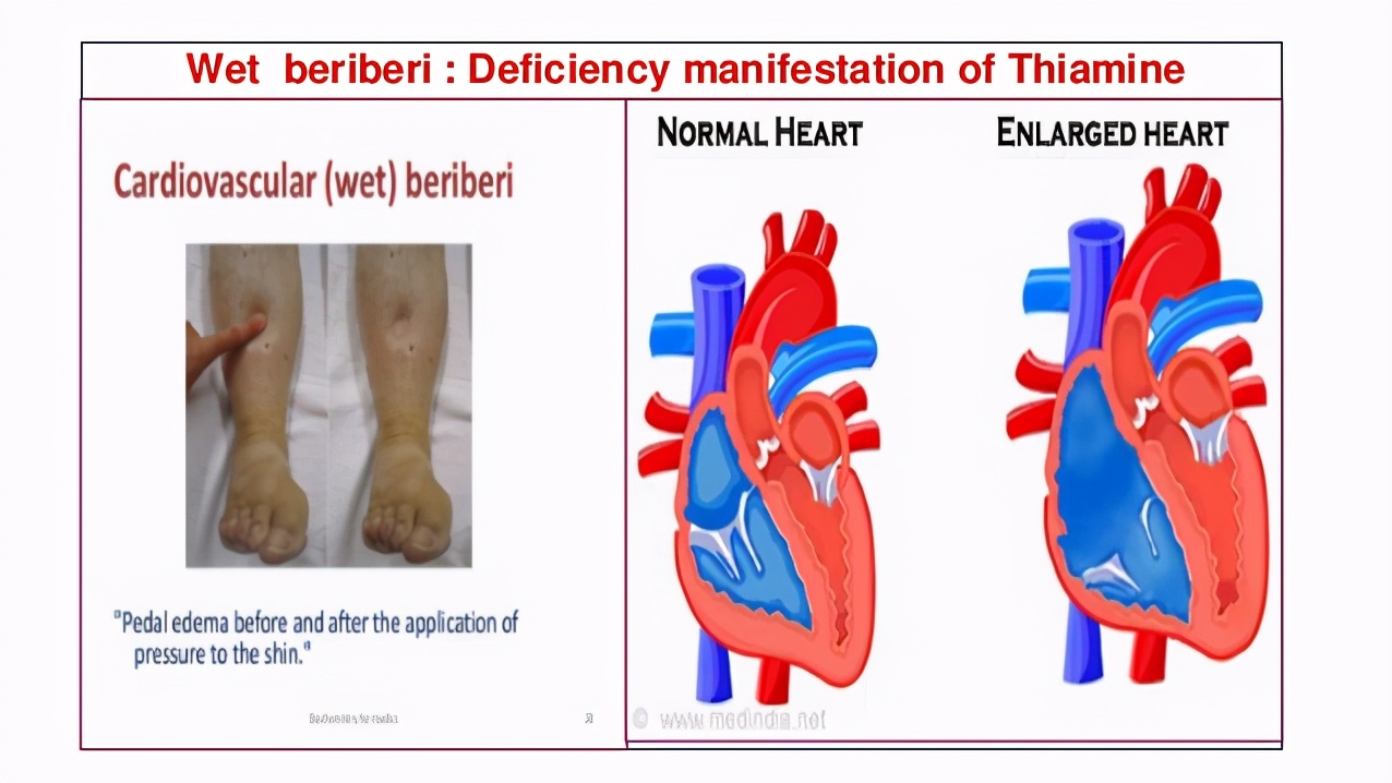 维生素b1缺乏脚气症状,维生素b1缺乏型脚气