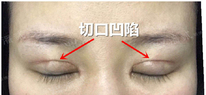 全切双眼皮提肌失败还能修复吗,什么是失败的双眼皮
