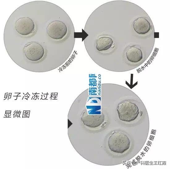 阿娇冷冻卵子,阿娇自曝怀孕冻卵