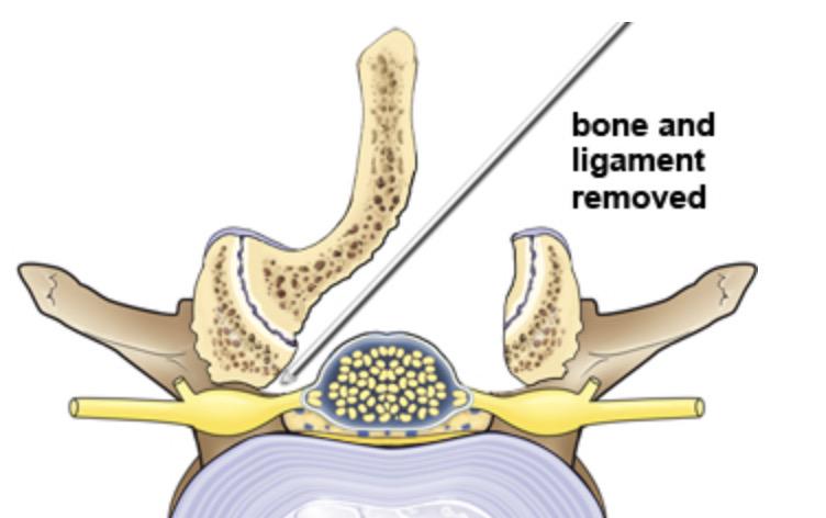 腰椎管狭窄症的基本诊断手段习题,骨科专家讲述腰椎管狭窄的原因