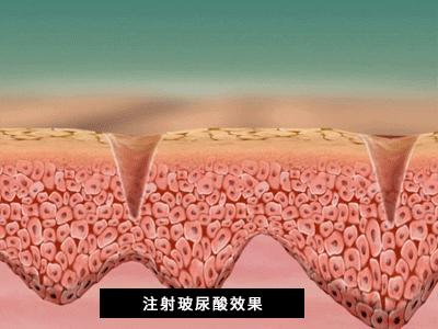 玻尿酸的保湿效果到底有多好？能让明星网红都纷纷跟风推荐