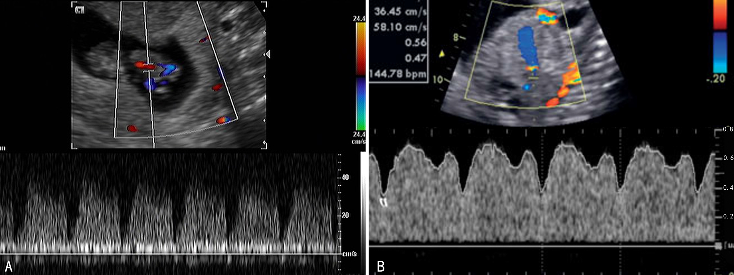 胎儿系统超声检查彩色多普勒,胎儿多普勒超声的一些数据