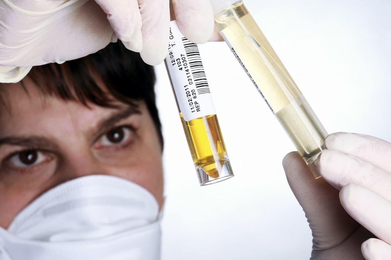 尿液颜色12种，不同色彩预示哪些疾病