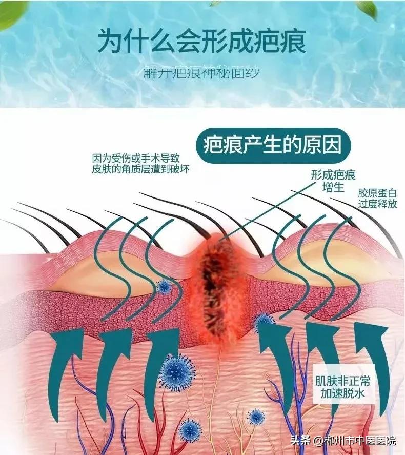 二氧化碳点阵激光被坑,二氧化碳点阵激光之后反黑怎么办