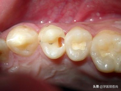 孩子换牙前的蛀牙需要处理吗,小孩蛀牙换牙前能不能拔牙